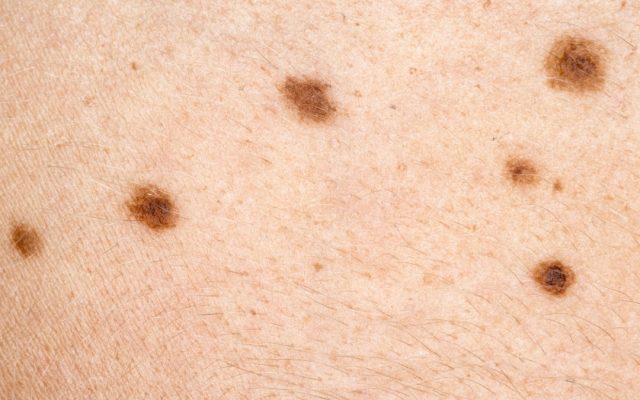 Dermatóloga advierte sobre el aumento del cáncer de piel