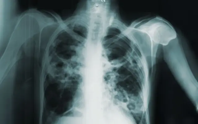 Salud incorpora dos equipos para diagnosticar tuberculosis