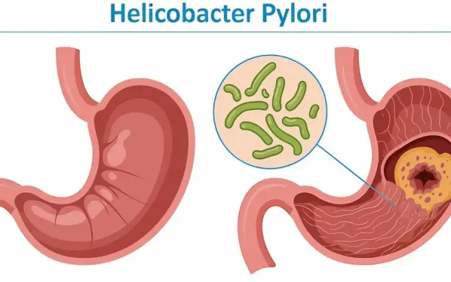 Helicobacter pylori estaría asociado al cáncer colorrectal